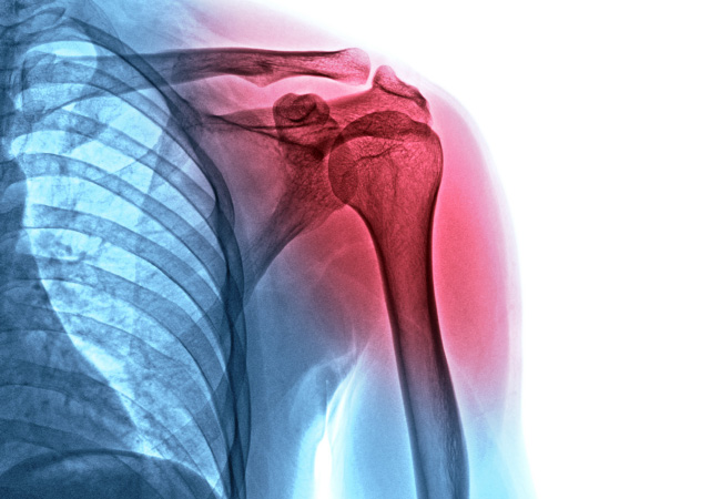 Physical Therapy Can Help Frozen Shoulders!